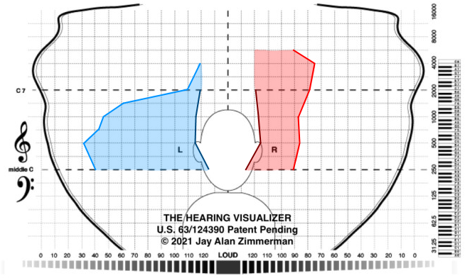 非對稱聽力損失個案的聽力具現圖